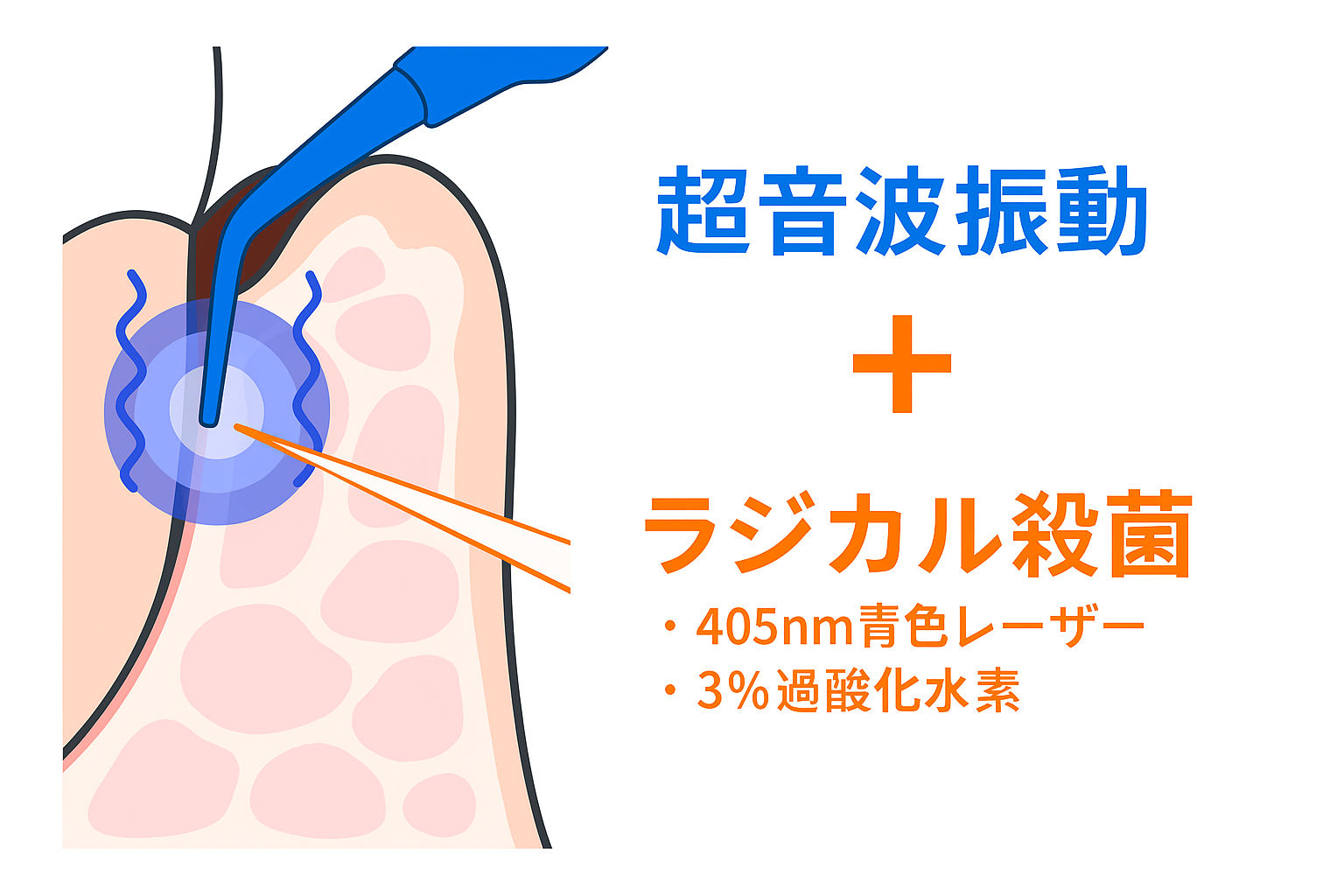 ブルーラジカル治療のイメージ